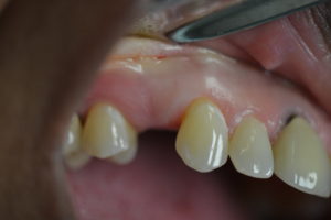 dental implant