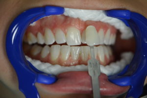 Zoom whitening